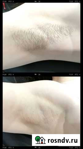 Шугаринг Йошкар-Ола - изображение 1