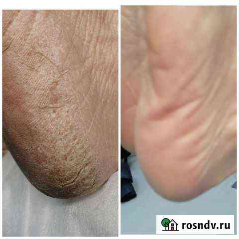 Педикюр аппаратный Череповец