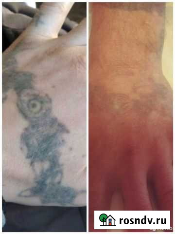 Выведение татуировок Барнаул - изображение 1