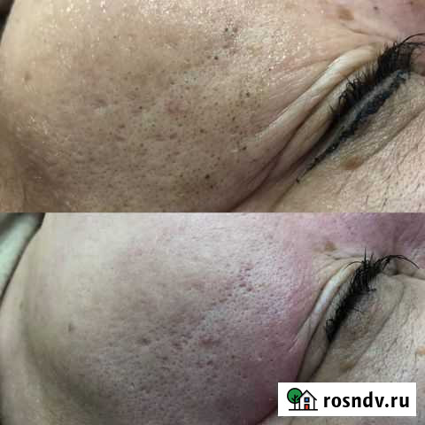 Чистка лица Сургут - изображение 1