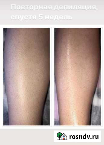 Шугаринг Магнитогорск - изображение 1