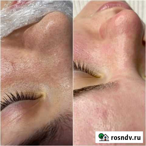 Чистка лица / косметолог Чебоксары - изображение 1