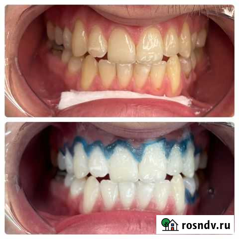 Отбеливание зубов Грозный - изображение 1