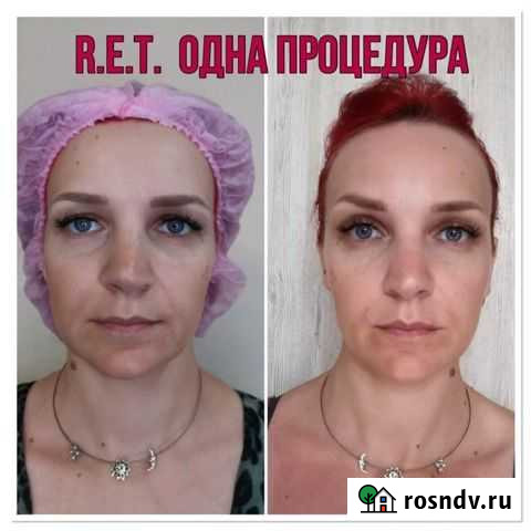 Аппаратная косм-гия (лицо).Естественное омоложение Калининград - изображение 1