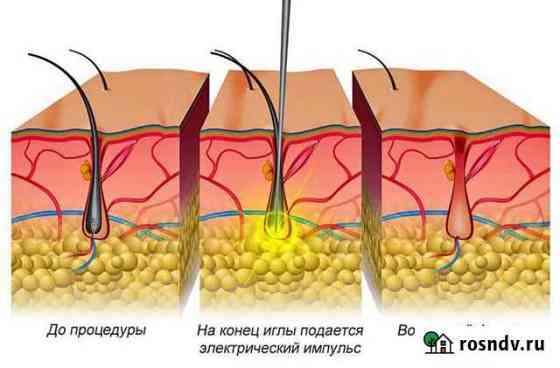 Электроэпиляция Нижний Новгород