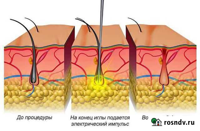 Электроэпиляция Нижний Новгород - изображение 1
