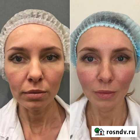Смас лифтинг процедура Краснодар - изображение 1
