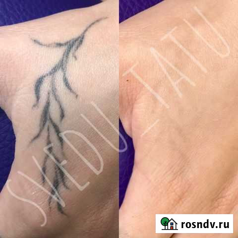 Лазерное удаление татуировок и татуажа Пирсинг Москва - изображение 1
