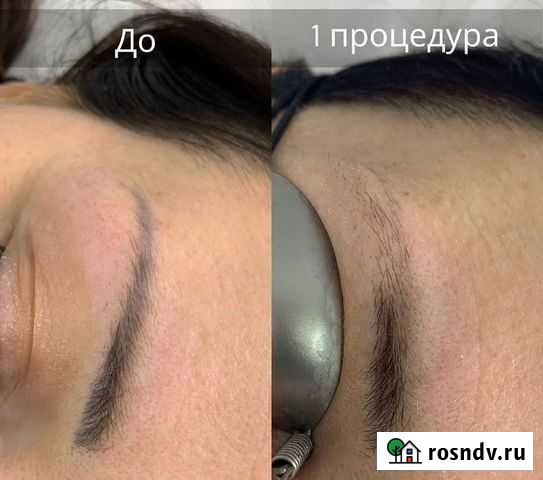 Удаление тату и перманентного макияжа Брянск - изображение 1