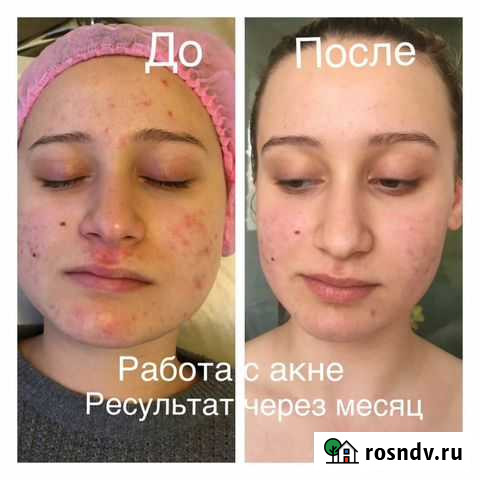 Услуги косметолога: массаж, чистка лица, пилинги Солнечногорск - изображение 1