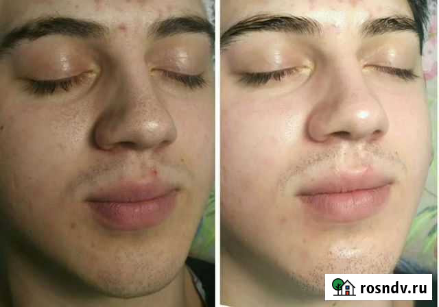 Чистка лица, спины, декольте Волгоград - изображение 1