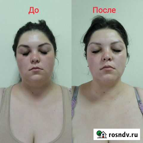 Ручная пластика лица Чебоксары - изображение 1