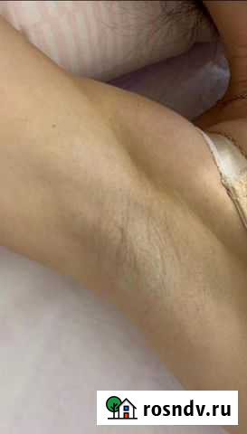 Лазерная эпиляция для мужчин и женщин Казань - изображение 1