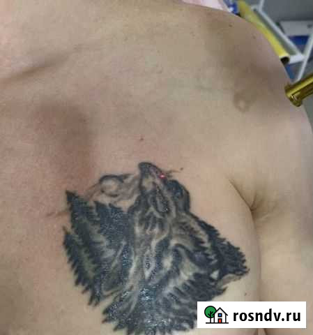 Удаление татуировки. Лазерная эпиляция волос Грозный - изображение 1