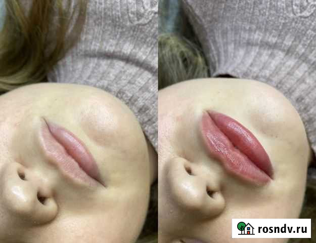 Косметолог чистка лица пилинги Пенза - изображение 1