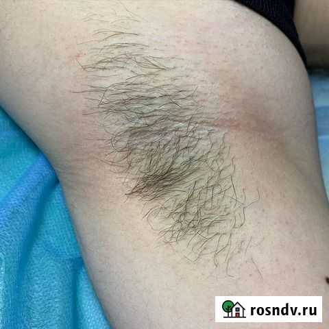 Электроэпиляция Махачкала - изображение 1