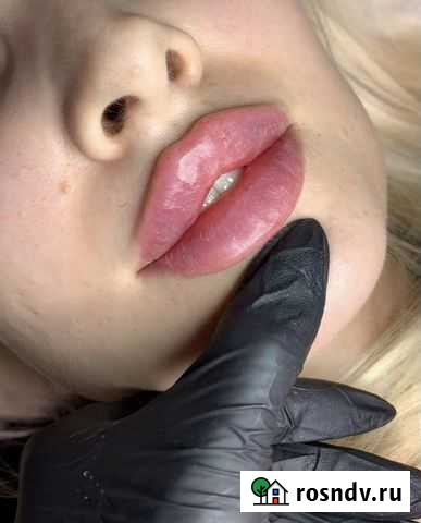 Контурная пластика губ Белгород - изображение 1