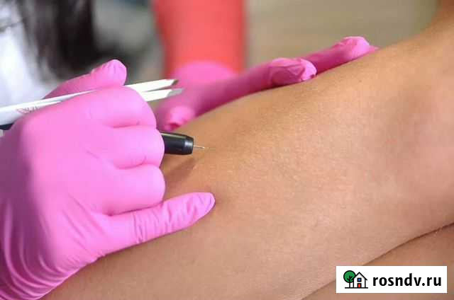 Электроэпиляция - удаление волос навсегда Набережные Челны - изображение 1