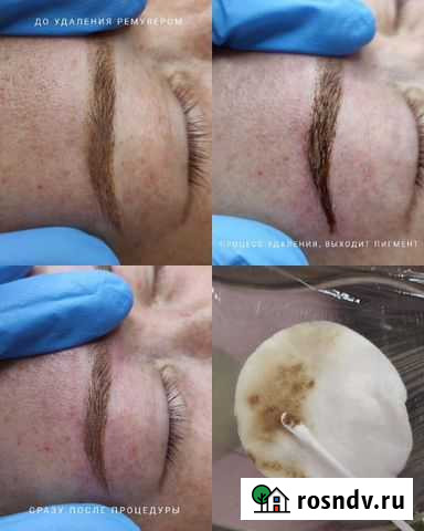 Удаление татуажа, тату. Карбоновый пилинг Москва - изображение 1