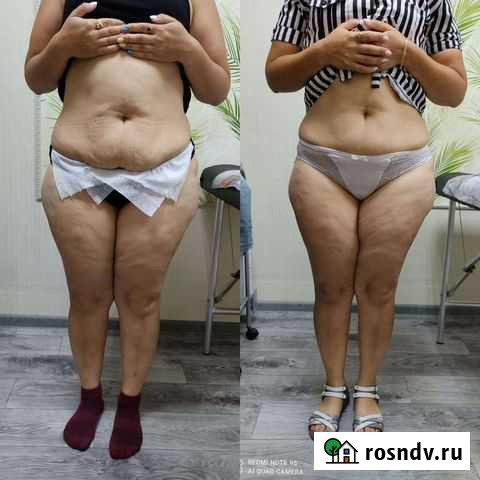 Аппаратный массаж Оренбург - изображение 1