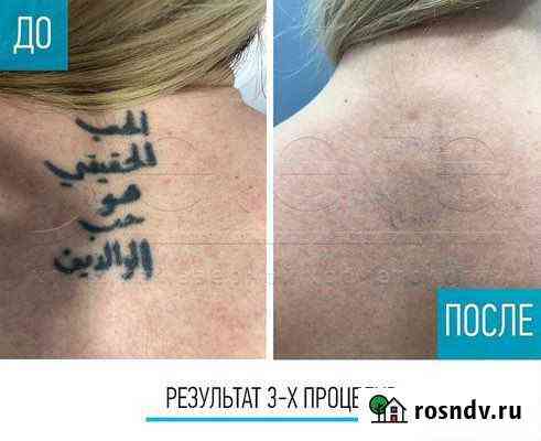 Лезенная эпиляция, Удаление татуировок Киржач