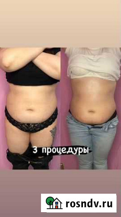 Массаж антицеллюлитный Мытищи - изображение 1