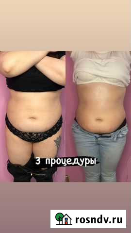 Массаж антицеллюлитный Мытищи - изображение 1