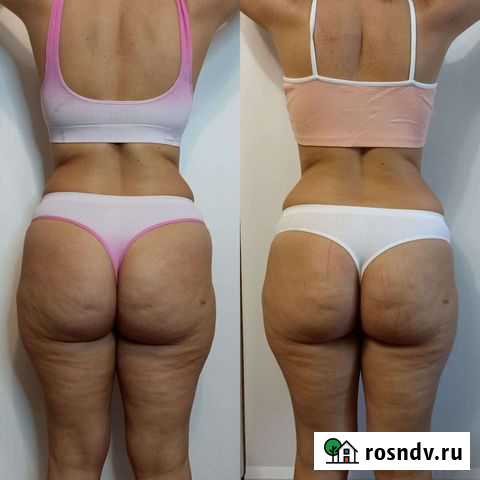 Коррекция фигуры, массаж лица Астрахань - изображение 1