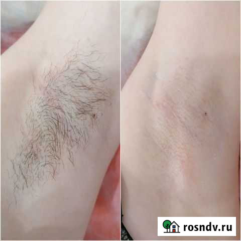 Депиляция Черногорск - изображение 1