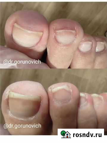 Мед. педикюр (подолог) Новокузнецк - изображение 1