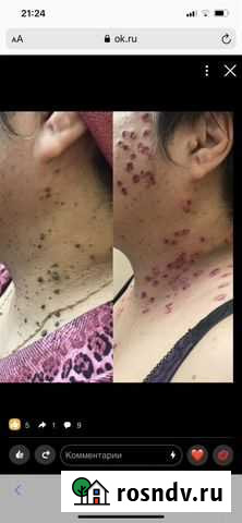 Удаление новообразований Канск - изображение 1