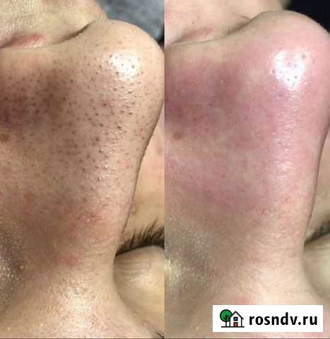 Чистка лица Лесной - изображение 1