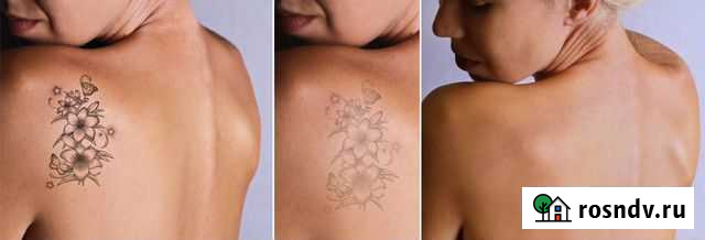 Лазерное удаление татуировок Красноярск - изображение 1