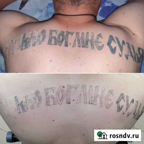 Удаление татуировок и татуажа неодимовым лазером Волгоград - изображение 1