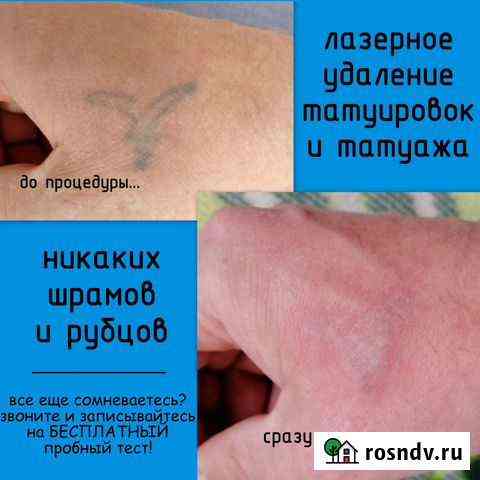 Удаление тату, татуажа и микроблейдинга Тихвин