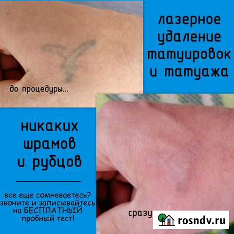Удаление тату, татуажа и микроблейдинга Тихвин - изображение 1