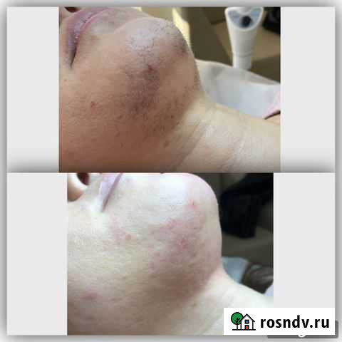 Электроэпиляция Краснодар - изображение 1