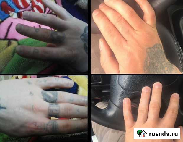 Удаление тату, Петрозаводск, Карелия Петрозаводск - изображение 1