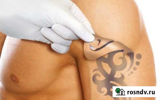 Удаление тату лазером Набережные Челны - изображение 1