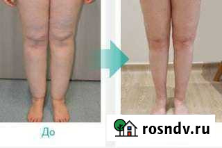 Лимфодренажный массаж Петрозаводск - изображение 1