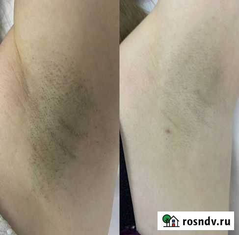 Лазерная эпиляция Ставрополь - изображение 1