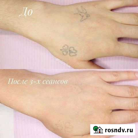 Удаление татуировок Астрахань - изображение 1
