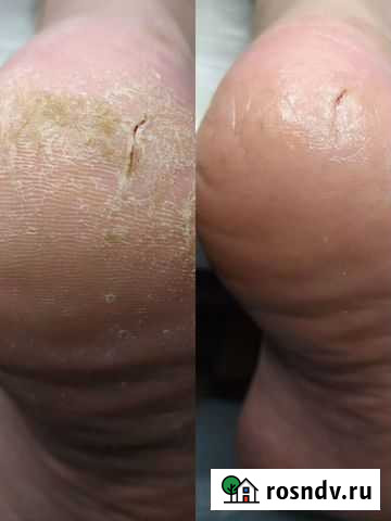 Подолог, педикюр Шумерля - изображение 1