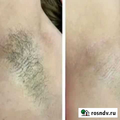 Депиляция женская Чебоксары - изображение 1