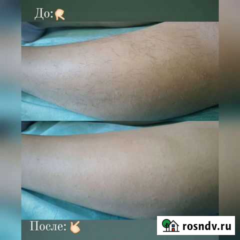 Шугаринг Оренбург - изображение 1