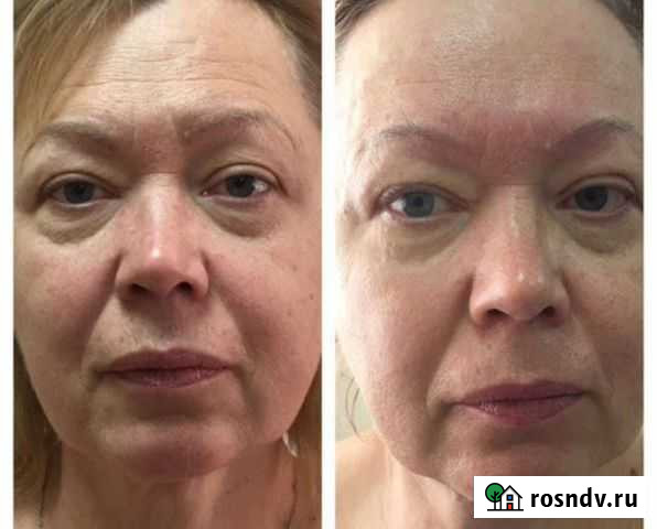 Лимфодренажный массаж лица Омск - изображение 1