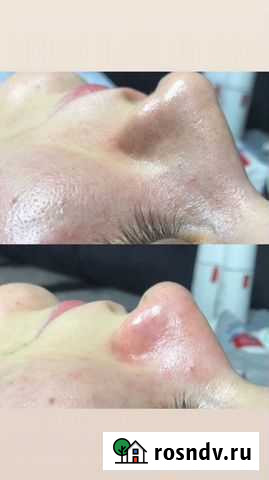 Косметолог чистка лица Махачкала - изображение 1