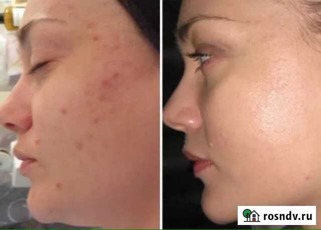 Комплексное восстановление кожи от акне, угрей Новосибирск - изображение 1