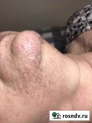 Электроэпиляция Волгоград - изображение 1