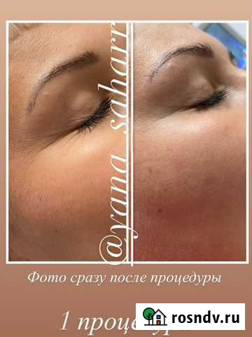 RF-лифтинг лица Новокузнецк - изображение 1